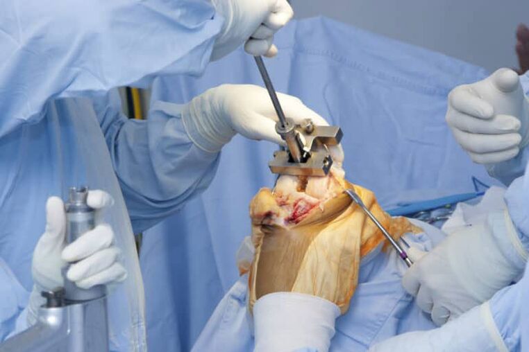 surgery for osteoarthritis of the knee