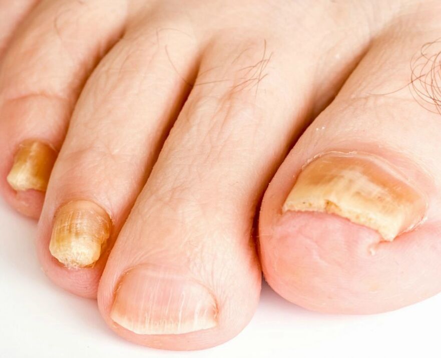 nail fungus
