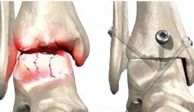 Surgical treatment of knee arthrosis