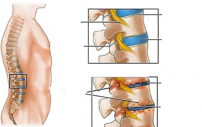 Lumbar osteochondrosis