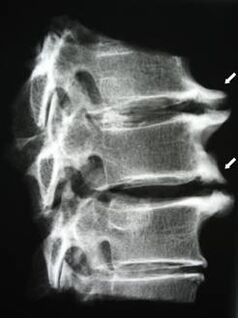 Osteophytes of the cervical vertebrae cause neck pain