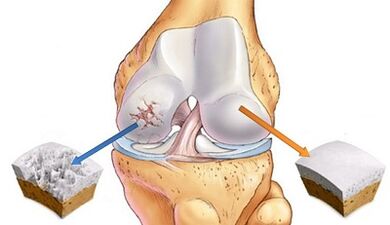 The causes of the development of arthrosis of the joints