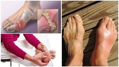 What is the arthritis of the joints