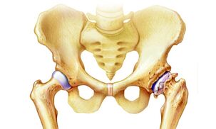 why osteoarthritis of the hip occurs