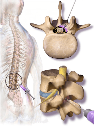 epidural corticosteroid injection